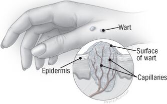 A estrutura da verruga na mão