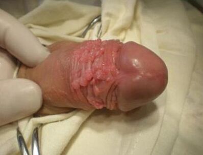Papilloma em um membro