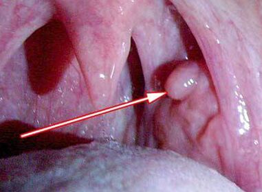 Papilloma na laringe