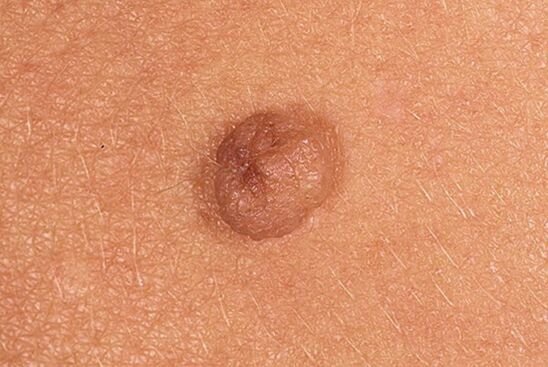 Papilloma simples