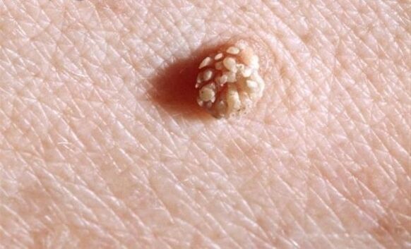 Papilloma sobre o corpo humano
