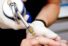 métodos para remover papilomas da pele
